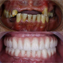 (COMPRE 1 LEVE 2) Dentadura de Silicone FIX | Ajustavel e Adaptativa + Kit de Limpeza de BRINDE
